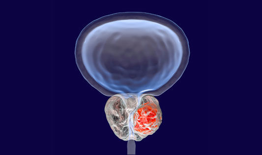 Prostataentzündung